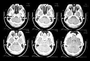 bigstock-Ct-Scan-Brain-9236744